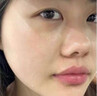 阿達帕林凝膠改得善毛孔粗大醫用祛的痘消炎痤瘡硬疙瘩專(zhuān)用藥痘痘粉刺痘印治療粉刺膿包皮膚用藥（視覺(jué)特效） 1盒裝【皮膚用藥 非處方藥】 曬單實(shí)拍圖