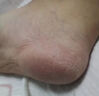 內廷上用骨刺貼膏根去腳后跟骨刺專(zhuān)用的藥足跟痛腳后跟疼痛骨刺增生100%藥 3盒*8貼 買(mǎi)二送一[發(fā)貨特效快] 治療足跟骨刺 曬單實(shí)拍圖