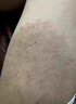 同仁堂醫(yī)用皮炎濕疹噴霧劑濕性液體敷料皮膚痤瘡干燥紅斑瘙癢外用官方 1瓶*30ml[體驗(yàn)裝] 曬單實(shí)拍圖