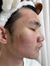 DR.AVIN【德國品牌】醫(yī)用痘坑修復凹洞填充再生長因子祛痘印淡化修復男BD 送醫(yī)用棉簽【兩盒裝】第二盒半價（小面積痘印痘坑） 曬單實拍圖