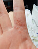修正汗皰疹濕疹止癢手起水泡癢脫皮干藥膏去根手上腳上兒童真菌感染Q9 1盒【體驗(yàn)裝】送棉簽  手掌小紅點(diǎn) 曬單實(shí)拍圖