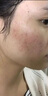 韓方五谷壬二酸祛痘藥膏去痘痘和淡化痘印精華液護(hù)膚品青春痘男女學(xué)生 曬單實(shí)拍圖