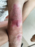 芭克kelocote美國疤克巴克硅凝膠兒童祛 疤膏疤痕膏疤痕輔助修復(fù)除疤 曬單實拍圖