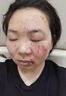 泰國鱷魚油去疤痕修復(fù)凝膠醫(yī)院專用去疤膏疤痕增生凸起去除疙瘩手術(shù)縫針修復(fù) 單盒裝 泰國祛疤修復(fù)愈合傷口 曬單實拍圖