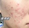 韓方五谷壬二酸祛痘藥膏去痘痘和淡化痘印精華液護膚品青春痘男女學(xué)生 曬單實拍圖