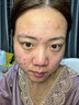 南京同仁堂祛痘膏去痘痘和痘印痘坑修復男女士改善粉刺閉口30g 曬單實拍圖