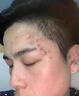 SKISGEM德國進(jìn)口祛痘膏去痘印痘坑痘疤修復(fù)凝膠消青春痘去粉刺精華液男女 【急救突發(fā)痘】一支裝*30g 曬單實(shí)拍圖