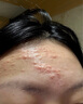 維特絲壬二酸祛痘藥膏去痘痘粉刺閉口收毛孔男女煙酰胺水楊酸青少年凝膠 曬單實(shí)拍圖