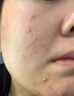 維特絲壬二酸祛痘藥膏去痘痘粉刺閉口收毛孔男女煙酰胺水楊酸青少年凝膠 曬單實拍圖