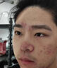 藤石制藥醫(yī)用玫瑰痤瘡專用修復(fù)凝膠皮膚屏障受損敏感肌泛紅面霜護(hù)膚品膏XT 3盒療程裝【第3盒0元】面部玫瑰痤瘡 曬單實(shí)拍圖