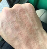 妙珍御醫(yī)堂去濕疹止癢根外用頑固皮炎手背癢長(zhǎng)疙瘩手上起小水泡過(guò)敏止癢乳膏 一盒裝 曬單實(shí)拍圖