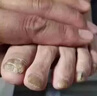 鹽酸阿莫羅芬芬搽劑灰指甲專用藥重度灰指甲專用藥甲癬壞甲空甲亮甲真菌感染鹽酸阿莫羅芬搽劑正品旗艦店 1盒 楚i迪鹽酸阿莫羅芬,乳.膏【灰指甲專用藥 曬單實拍圖