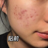 Newliann醫(yī)用祛痘貼去痘痘和痘印消炎吸膿隱形修復(fù)膏淡化痘坑痤瘡專用制藥 曬單實拍圖