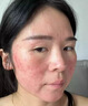 藤石制藥醫(yī)用玫瑰痤瘡專用修復(fù)凝膠皮膚屏障受損敏感肌泛紅面霜護(hù)膚品膏XT 1盒試用裝【醫(yī)用玫瑰痤瘡修復(fù)凝膠】不滿意可退款 曬單實(shí)拍圖