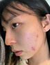 香港大藥房有限公司祛痘膏和痘印坑修復(fù)痘痘和痘印青春痘消炎痤瘡粉刺專用 曬單實拍圖