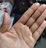 汗皰疹100%特專(zhuān)用效藥濕疹特瘙癢效藥止癢去治根手指上癢起小水泡止癢抑菌膏脫皮真菌感染阿昔洛韋乳膏 1盒【手癢起小水泡止癢專(zhuān)用藥】 曬單實(shí)拍圖