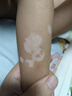 海外進口白癜風藥膏Rutinib Cream 魯嗦替泥軟膏 蘆可替泥乳膏白班病專用 復發(fā)性皮炎頑固性 耀品Rutinib cream一支 曬單實拍圖