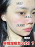 Newliann醫(yī)用械字號洗面奶狀潔面乳控油祛痘除螨蟲去黑頭男士女士修復(fù)屏障 曬單實拍圖