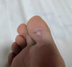 雞眼去除(發(fā)貨特效率)專(zhuān)用藥雞眼膏去看看根肉刺刺猴藥膏無(wú)痛脫落連根藥拔跖疣專(zhuān)用藥老繭水楊酸苯酚貼膏 1盒【皮膚增厚輕微疼痛】水楊酸i軟膏50%去雞眼 曬單實(shí)拍圖