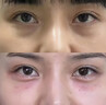 全國門店雙眼皮手術(shù)眼袋提眉切眉眼綜合手術(shù) 預(yù)約定金 曬單實(shí)拍圖