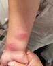 埃姆登制藥蚊蟲叮咬止癢消腫嬰兒成人藥膏基孔肯雅熱治蚊子跳蚤臭蟲螨蟲咬藥 1盒裝【無激素】 曬單實拍圖