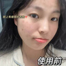 維特絲壬二酸祛痘藥膏去痘痘粉刺閉口收毛孔男女煙酰胺水楊酸青少年凝膠 曬單實拍圖