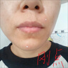 點痣膏美容的院專用官的方正品點疣藥水去痣點痣膏疤痕修復液醫(yī)用 一盒裝 曬單實拍圖