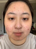 錦婷痘印型凝膠導光凝膠去痘青春粉刺痘印型導光凝膠去痘淡化痘印痘坑痤瘡閉口改善祛痘凝膠 一支裝(20g/支) 曬單實(shí)拍圖
