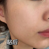Newliann醫(yī)用祛痘貼去痘痘和痘印消炎吸膿隱形修復(fù)膏淡化痘坑痤瘡專用制藥 曬單實拍圖