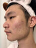 DR.AVIN【德國品牌】醫(yī)用痘坑修復凹洞填充再生長因子祛痘印淡化修復男BD 送醫(yī)用棉簽【兩盒裝】第二盒半價（小面積痘印痘坑） 曬單實拍圖