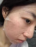 悠伊美醫用冷敷型膠原蛋面膜術(shù)后曬后敏感肌修護祛紅腫祛痘肌膚敷料女  二盒10片 曬單實(shí)拍圖