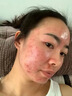 甲硝唑凝膠祛痘消炎痤瘡專用藥膏去痘痘印青春痘皮膚用藥青少年痤瘡硬疙瘩臉上下巴紅腫硬額頭粉刺炎癥性丘疹 1盒【國藥OTC】 曬單實(shí)拍圖