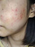 維特絲壬二酸祛痘藥膏去痘痘粉刺閉口收毛孔男女煙酰胺水楊酸青少年凝膠 曬單實(shí)拍圖
