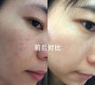 維特絲祛痘藥膏50g壬二酸水楊酸去痘痘和收毛孔閉口粉刺男女精華 曬單實(shí)拍圖