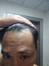 【超實(shí)惠加量裝】達(dá)霏欣 米諾地爾酊搽劑5%濃度療程裝210ml【脫發(fā)嚴(yán)重 男士專用】防脫生發(fā)育發(fā)發(fā)際線增長液洗發(fā)水脫發(fā)斑禿泡沫凝膠京東自營達(dá)菲欣 曬單實(shí)拍圖