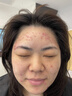 維特絲祛痘藥膏50g壬二酸水楊酸去痘痘和收毛孔閉口粉刺男女精華 曬單實(shí)拍圖
