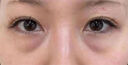 焦博士日本眼膜眼袋貼提拉緊致抗皺淡化細(xì)紋黑眼圈眼貼膜補(bǔ)充膠原蛋白 曬單實(shí)拍圖