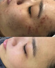 OHBT祛痘膏60g青春痘閉孔粉刺收縮毛孔專用學(xué)生男女凝膠男士化妝品 曬單實拍圖
