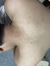興福堂后背祛痘噴霧前胸口背部身體去痘美背水楊酸背粒消身體噴霧100ml 曬單實拍圖