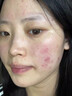 維特絲壬二酸祛痘藥膏煙酰胺凝膠去痘痘粉刺閉口男女水楊酸收毛孔青少年 曬單實(shí)拍圖
