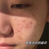 維特絲壬二酸祛痘藥膏煙酰胺凝膠去痘痘粉刺閉口男女水楊酸收毛孔青少年 曬單實(shí)拍圖