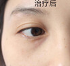 臺潤京田臺潤脂肪粒去除神器汗管廇眼部祛眼周眼角油脂粒京河華寧臺潤 療程裝3盒 曬單實(shí)拍圖