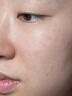 醫用精華液械字號收縮毛孔粗大修復細致去黑頭粉刺閉口男士女士祛痘印黑色素沉淀控油淡化痘印痘坑透明質(zhì)酸鈉 曬單實(shí)拍圖
