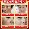 胖東來(lái)美白祛斑霜強(qiáng)效第1名100%淡化老年黃褐雀斑黑色素一夜消專(zhuān)用的藥 2025新科技 男女醫(yī)用【1支裝】 曬單實(shí)拍圖