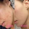 維特絲壬二酸祛痘藥膏煙酰胺凝膠去痘痘粉刺閉口男女水楊酸收毛孔青少年 曬單實拍圖