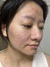 DR.AVIN【德國品牌】醫(yī)用痘坑修復凹洞填充再生長因子祛痘印淡化修復男BD 送醫(yī)用棉簽【兩盒裝】第二盒半價（小面積痘印痘坑） 曬單實拍圖