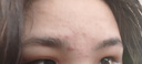 薇諾娜凈痘清顏3件套洗面奶爽膚水面霜水乳護膚品套裝七夕禮物 曬單實拍圖