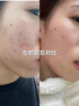 OHBT祛痘膏60g青春痘閉孔粉刺收縮毛孔專用學(xué)生男女凝膠男士化妝品 曬單實拍圖