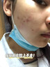 南京同仁堂祛痘膏去痘痘和痘印痘坑修復男女士改善粉刺閉口30g 曬單實(shí)拍圖
