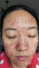 醫(yī)用冷敷貼面膜械字號(hào)醫(yī)美術(shù)后消炎美白補(bǔ)水曬后修復(fù)收縮毛孔祛痘淡化痘印生長(zhǎng)因子重組三型人源膠原蛋白敷料 曬單實(shí)拍圖